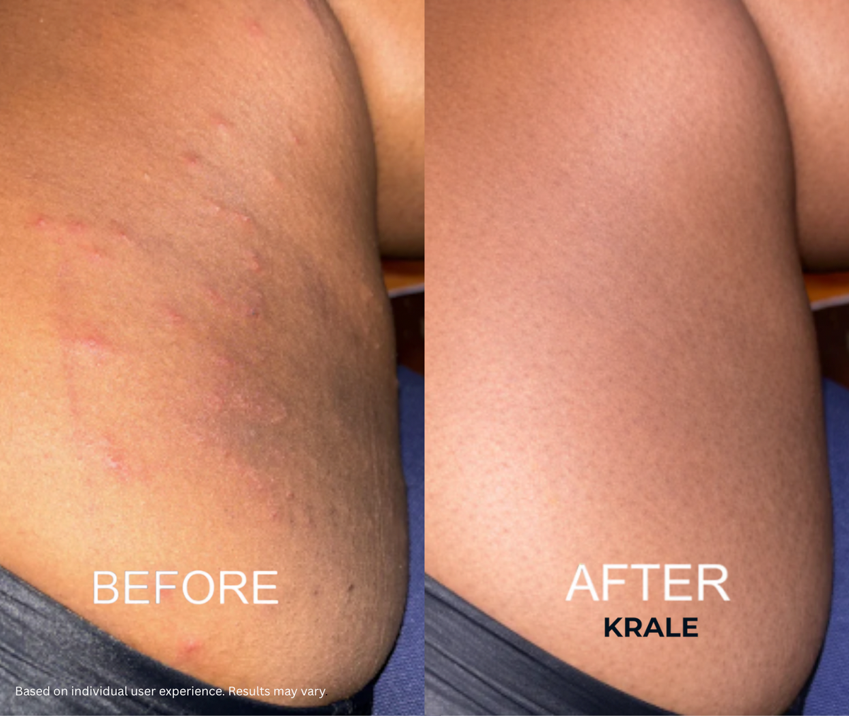 ThighBright Repair System™